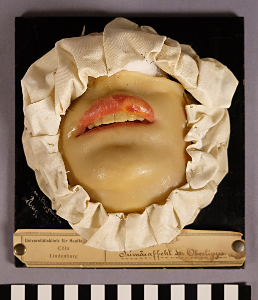 En vaxavgjutning med en fastnålad tyglinning är fäst på en svartmålad träpanel. Bilden föreställer den nedre delen av ansiktet på en patient, närmare bestämt munnen med en svullen överläpp. 