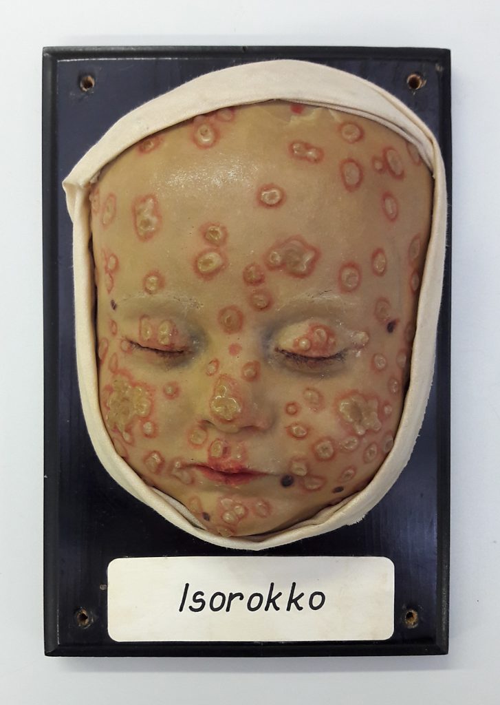 The face of a waxwork baby is completely covered by large suppurating pustules.