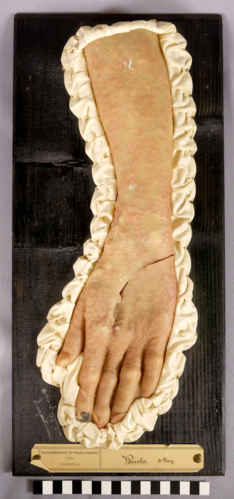 A wax model of a hand and arm attached to a black backplate. A dense rash of vesicles can be seen on the skin, and the nail of the index finger has turned dark. The model is surrounded by a white folded fabric.