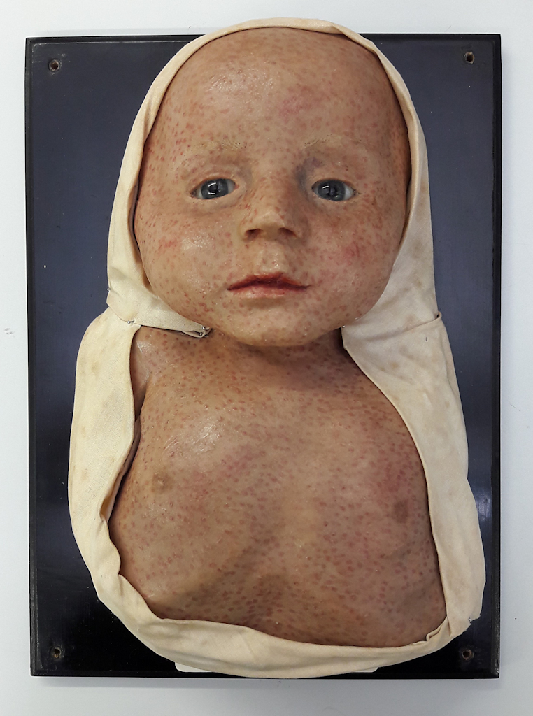A wax model attached to a black background and surrounded by white fabric, depicting an infant under the age of one. The model shows the child’s face, neck and chest interspersed with small red dots.