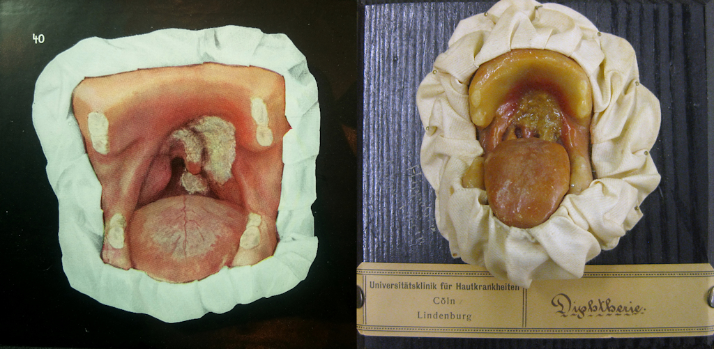 Two colour photos side by side. Both photos show a wax model with an open mouth. There are white patches of coating in the throat area. However, the two models are not very similar. 