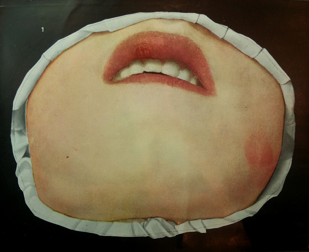 A photo of a wax model against a black background and surrounded by a white fabric. The model shows the bottom part of a patient’s face, primarily the mouth, with a swollen upper lip. There is a red blotch on the patient’s cheek. The wax model resembles the first photo in this blog post, but appears drawn, rather than a real wax model.