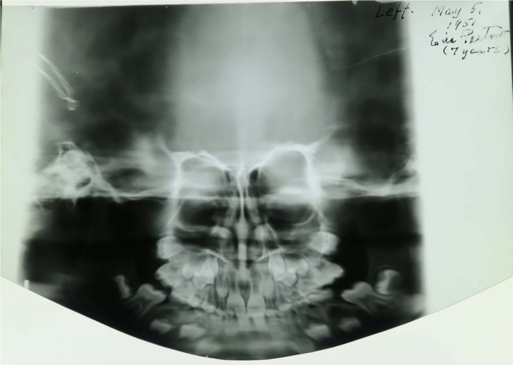 Alareunastaan kaareva röntgenkuva, jonka yläreunaan käsin kirjoitettu englanninkielinen teksti kertoo, että kuva on otettu 5.5.1951 seitsemänvuotiaasta Eira Paaterosta.